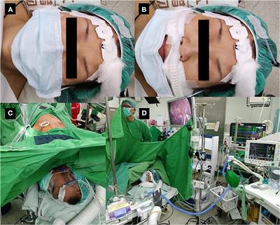 Non-intubated Thoracoscopic Surgery to Minimize Contamination From Airway Secretions During the COVID-19 Pandemic